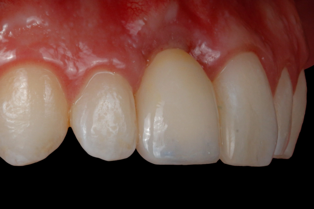 D'Amico Dental Care - top rated implant dentist - https://www.youtube.com/watch?v=k4crfuVf2to