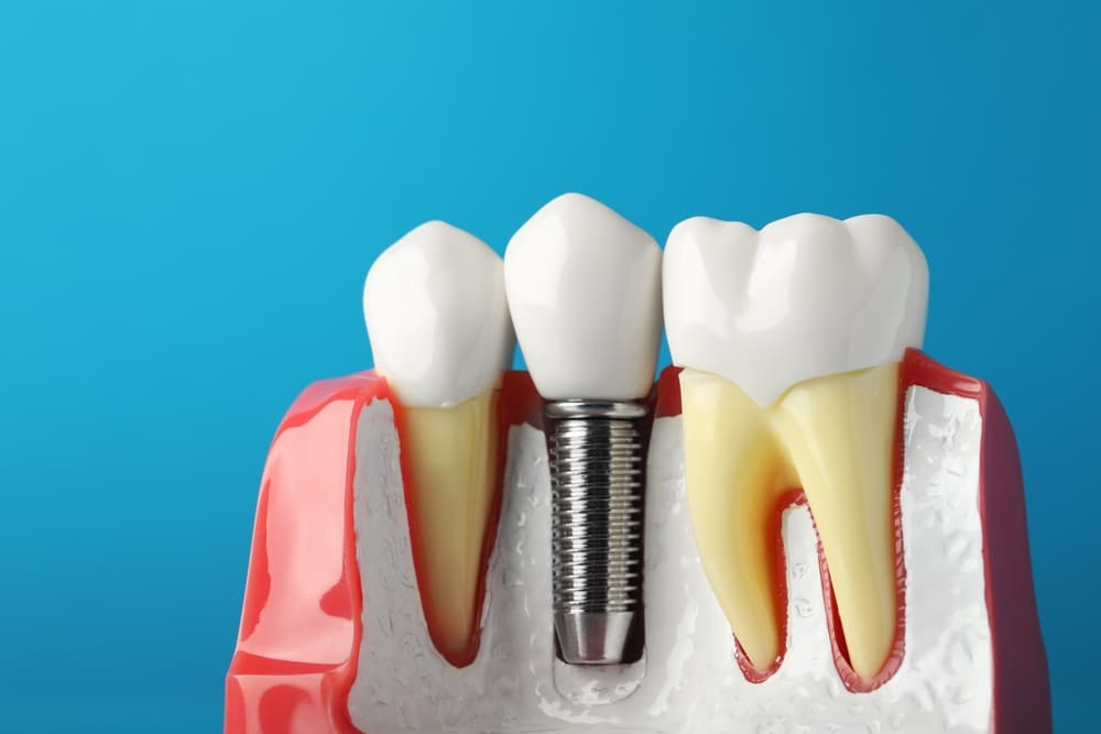 What Are Dental Implants