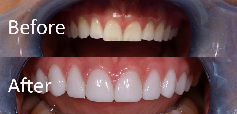 D'Amico Dental Care - Porcelain Veneers - Porcelain veneers significantly improve dental aesthetics by creating a uniform and harmonious surface. These restorations, with their natural enamel-like optical properties (refractive index 1.52-1.54) and selective light transmission capability, impart natural depth and dimension to teeth. The ceramic layering technique (stratification technique) enables precise color matching with adjacent teeth. Studies demonstrate this method can reduce light absorption by up to 45% while improving light reflection by 60%.