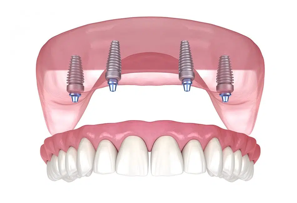 All-on-4 Implants