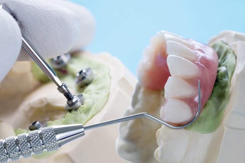 Average Dental Implants Lifespan 