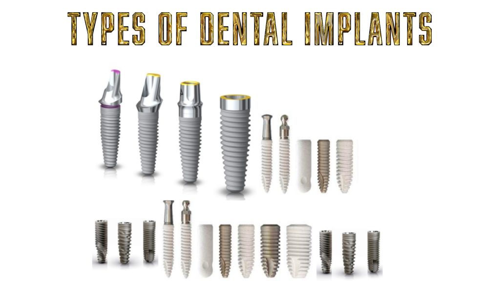 Types Of Dental Implants