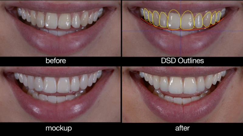 Digital Smile Design in Different Dental Procedures