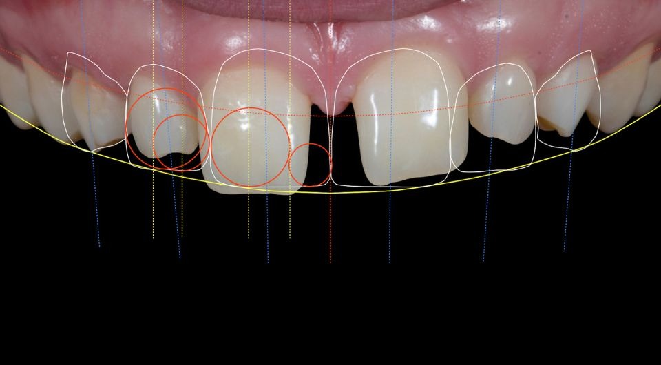 Disadvantages of Digital Smile Design