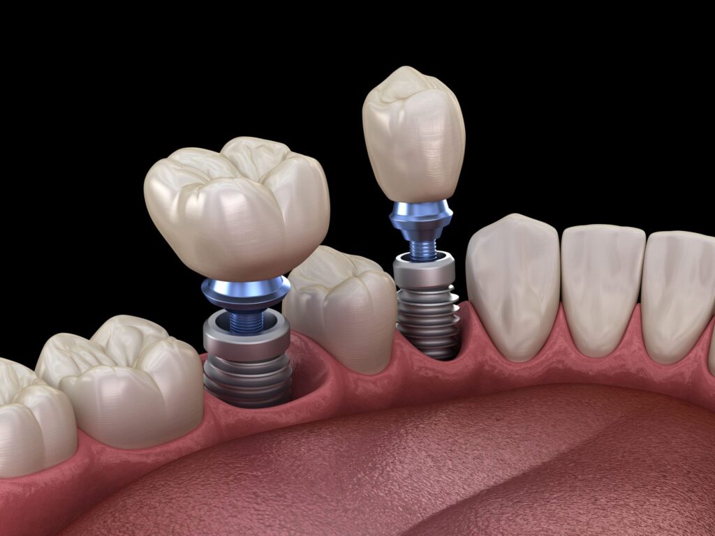 Endosteal Implants