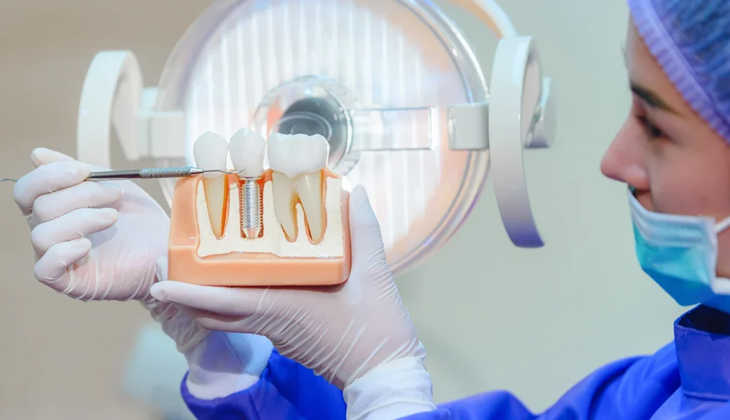 Lifespan of Dental Implants
