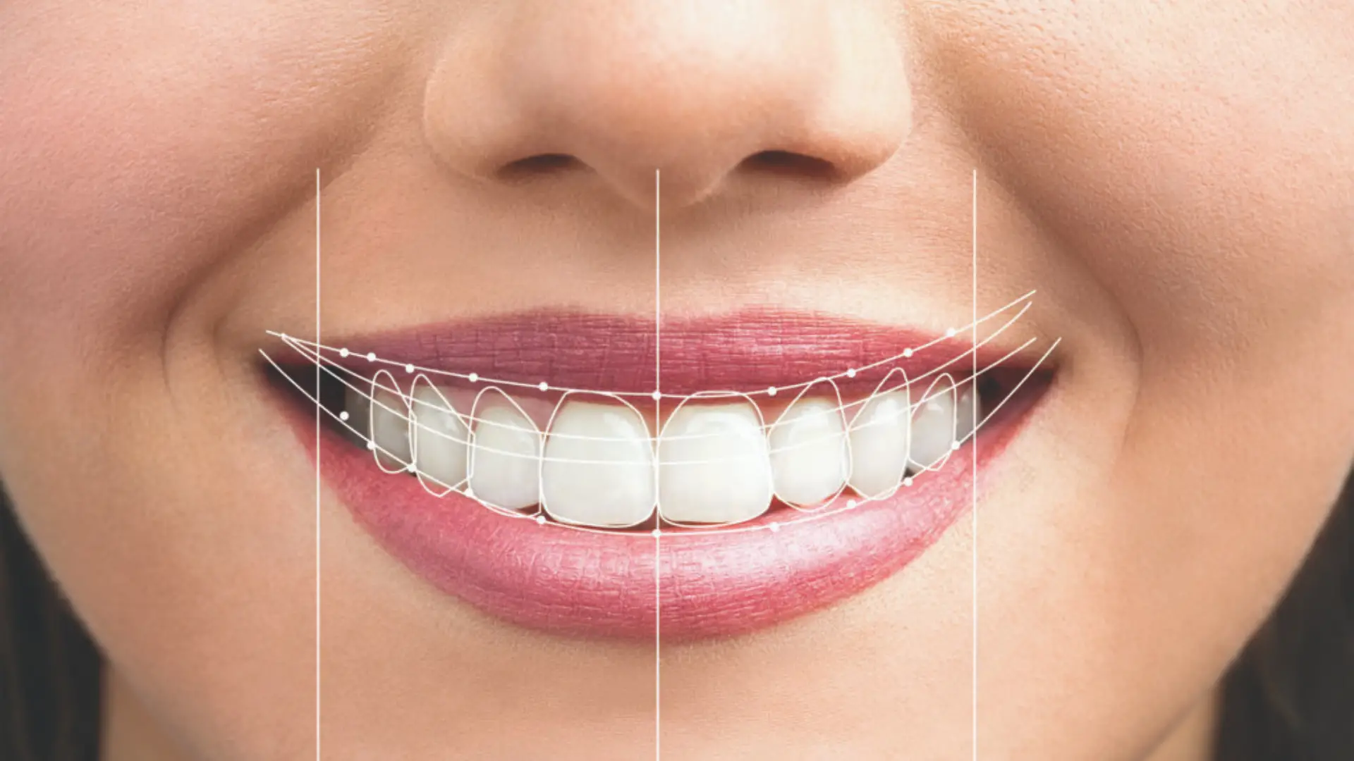 Patient Experience with Digital Smile Design