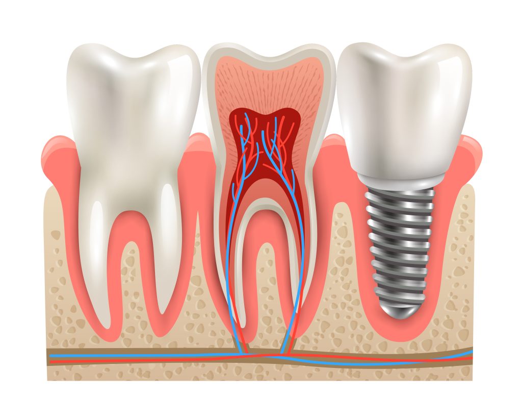 What Happens During the Healing and Osseointegration Phase