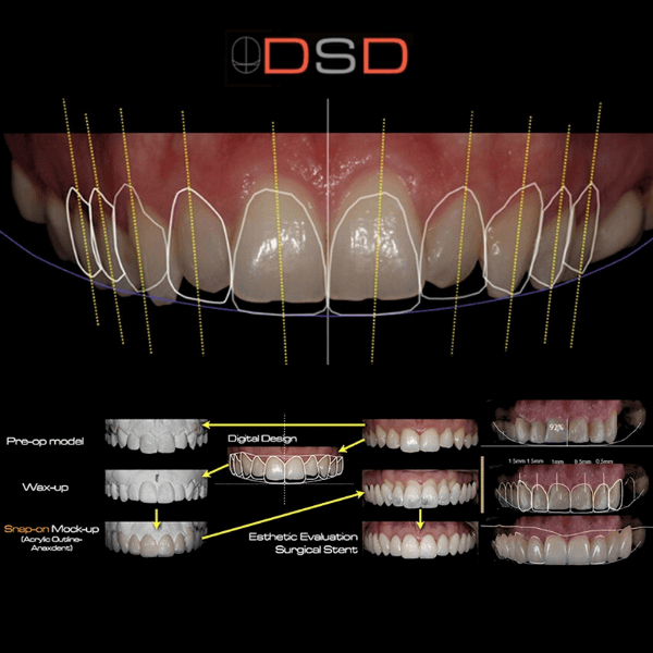 What is Digital Smile Design