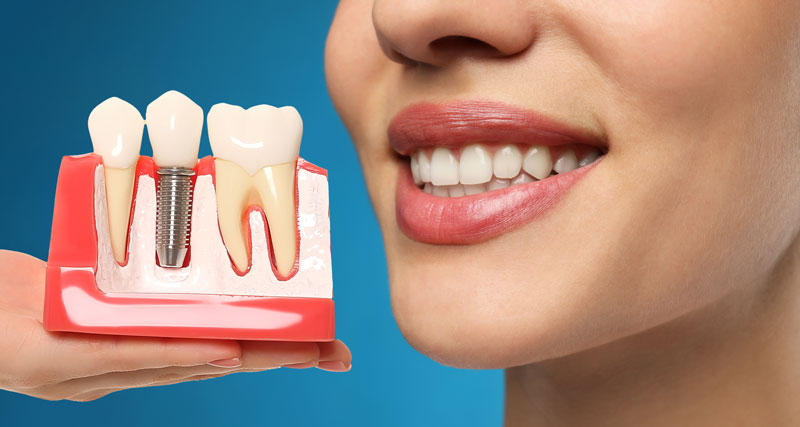 D'Amico Dental Care - 5 Benefits of Dental Implants - The benefits of dental implants extend far beyond just dental health. They restore your confidence with a natural-looking smile and allow you to enjoy all your favorite foods without restrictions. Unlike removable dentures, implants are permanently fixed and require no adhesives or special cleaning routines - just regular brushing and flossing like natural teeth. If you're looking for a permanent, comfortable, and natural-looking solution for missing teeth, dental implants are undoubtedly the best choice available today. Their combination of functionality, aesthetics, and longevity makes them the most advanced tooth replacement option in modern dentistry.