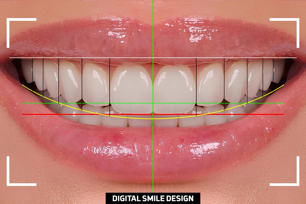 digital smile design advantages