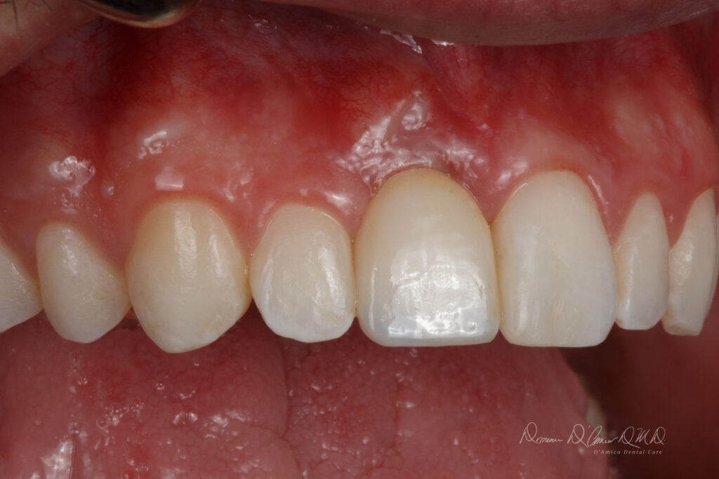 How Long Do Immediate Dental Implants Last