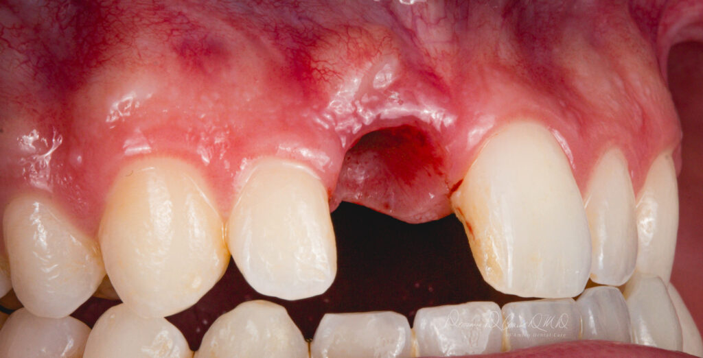 Benefits of Immediate Implants