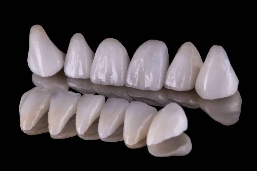 Average Lifespan of Veneers