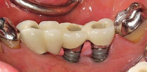 Bone Loss Around Implants