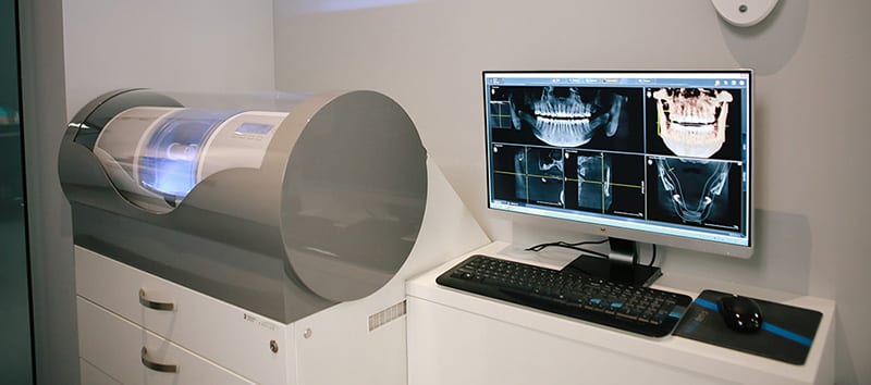 CEREC vs Traditional Crowns