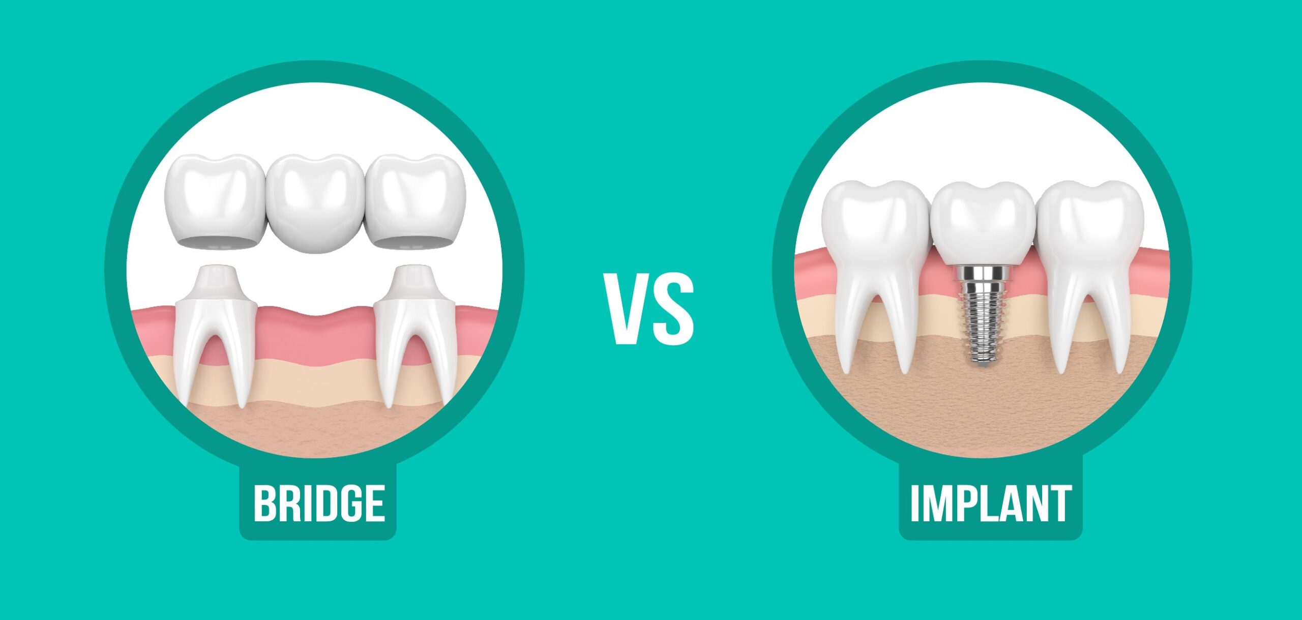 Dental Implants vs. Bridges