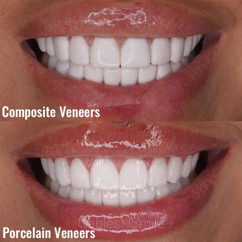 Differences Between Composite and Porcelain Veneers