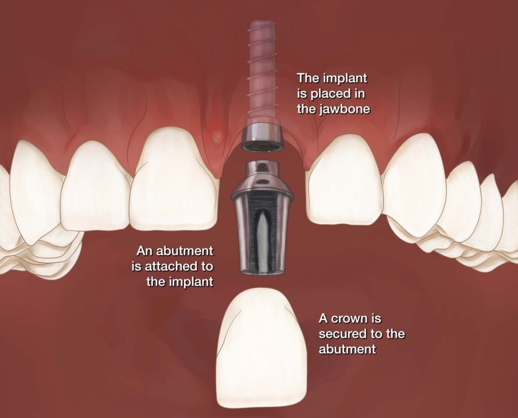  Front Tooth Implant