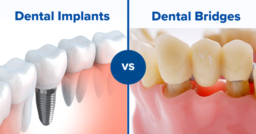 Front Tooth Implant vs Bridge