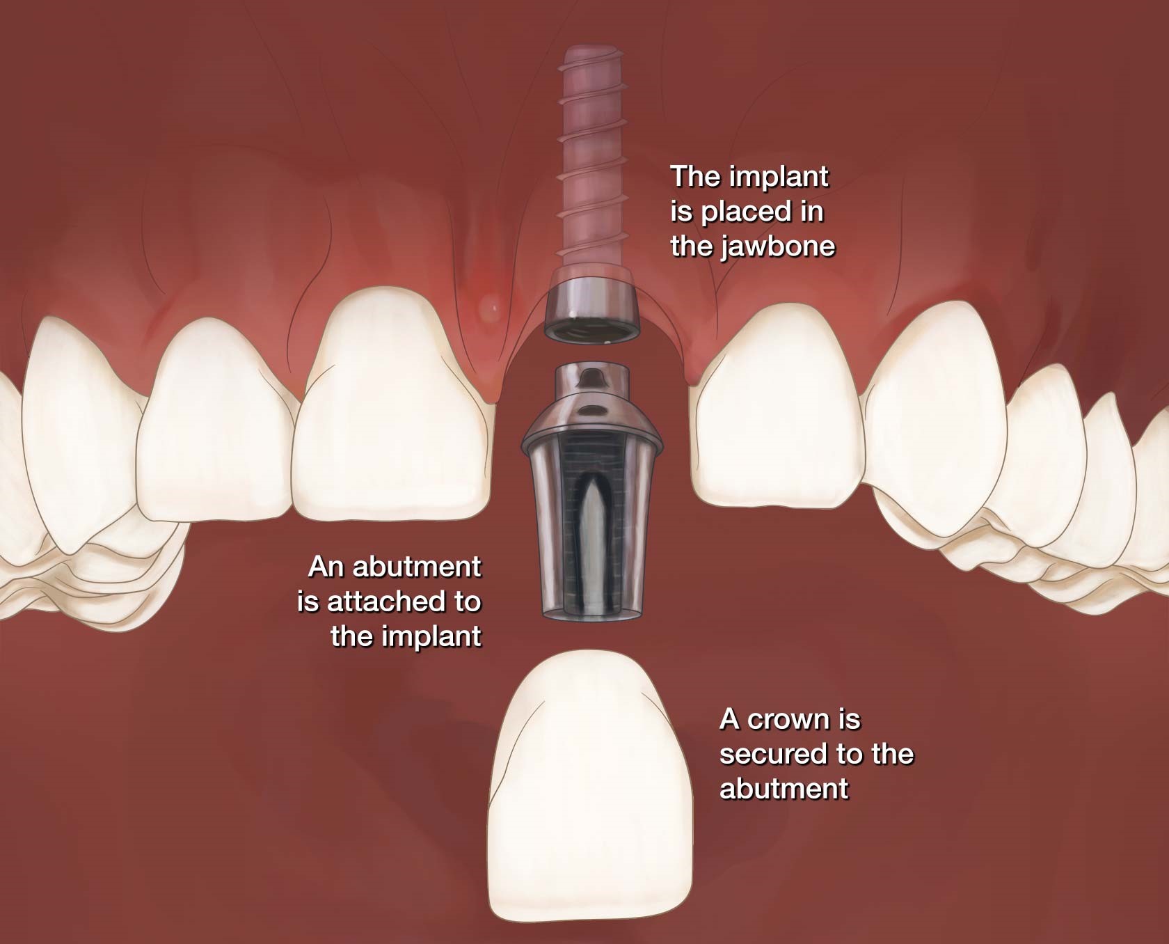 Front Tooth Implant