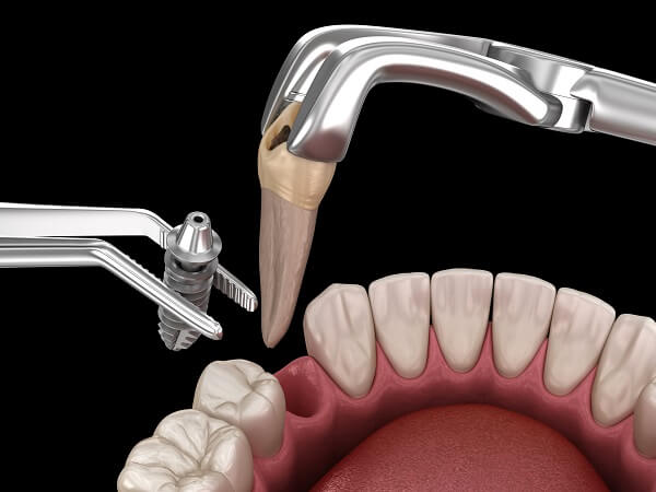 Immediate Implant Procedure