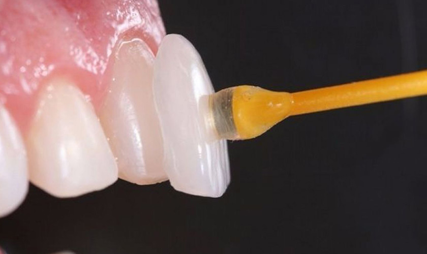 Maximizing the Lifespan of Porcelain Veneers