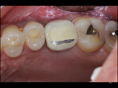 Mechanical Failure of Dental Implants