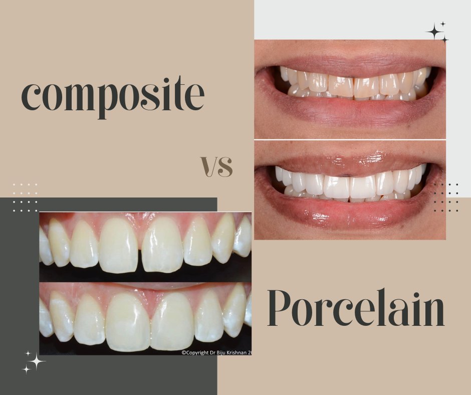 Porcelain Veneers vs. Composite Veneers