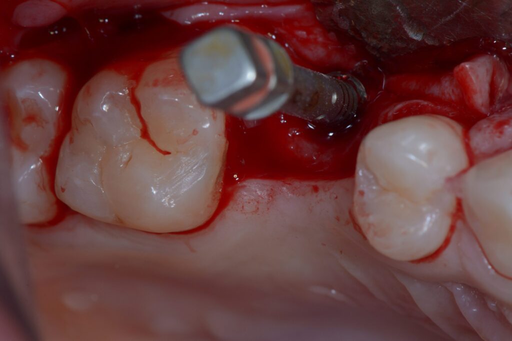 Prolonged Bleeding After Implant Surgery