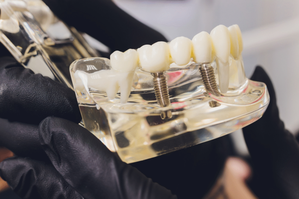 Role of Your Dentist in Implant Planning