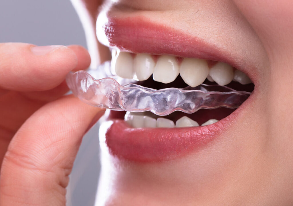 What Is Invisalign
