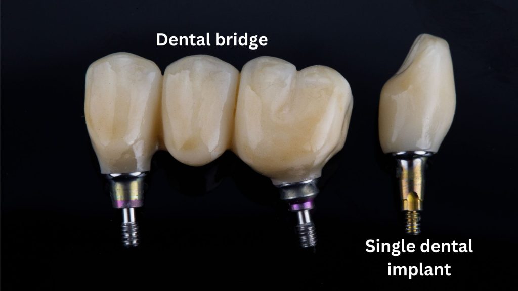 difference between implants and bridges