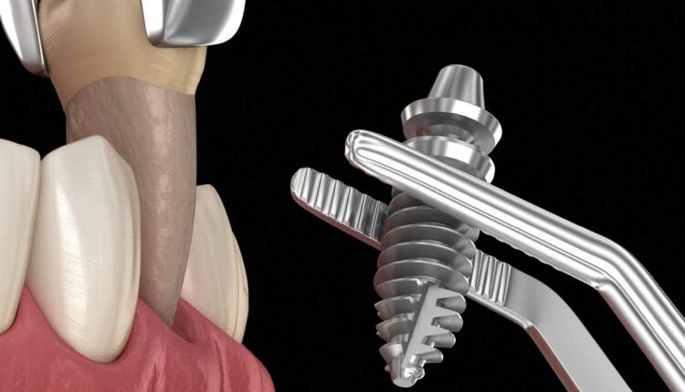 Immediate Dental Implants