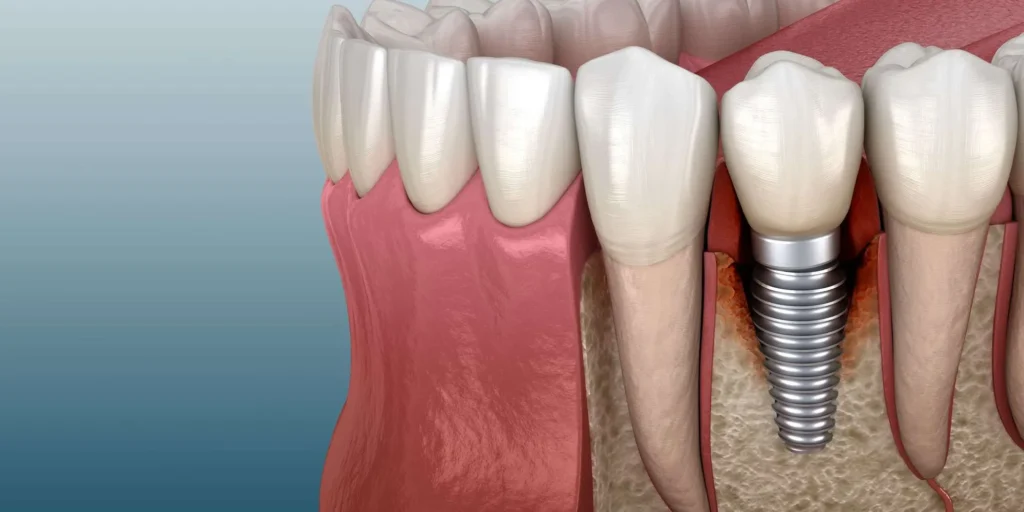 Dental implant failure