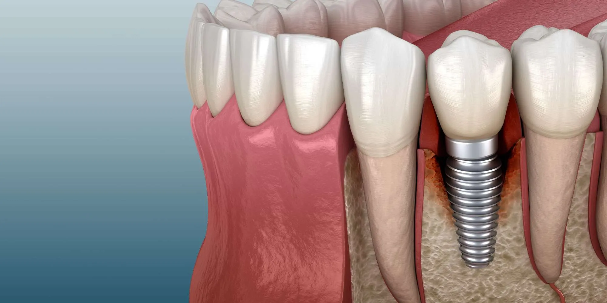 Dental implant failure