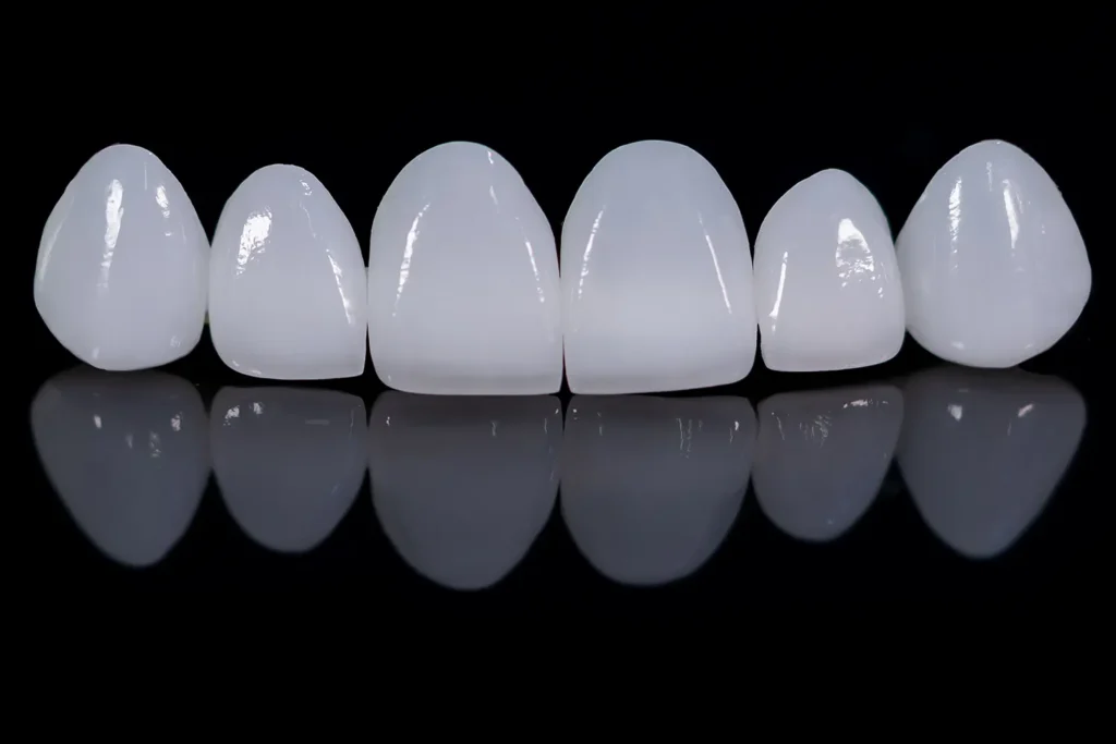 porcelain veneer lifespan