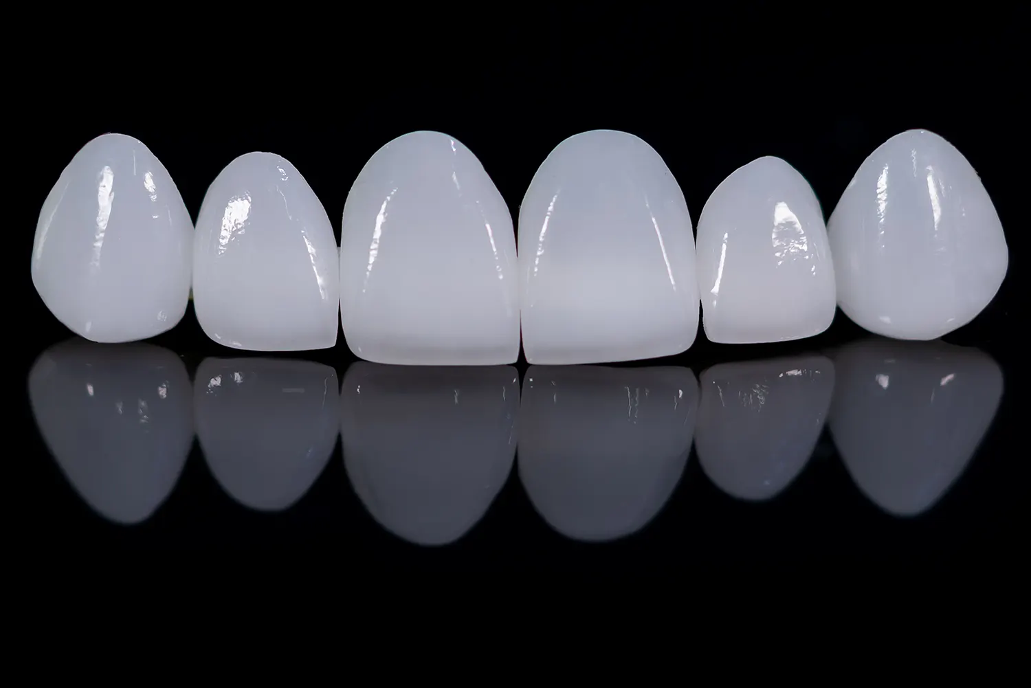 porcelain veneer lifespan