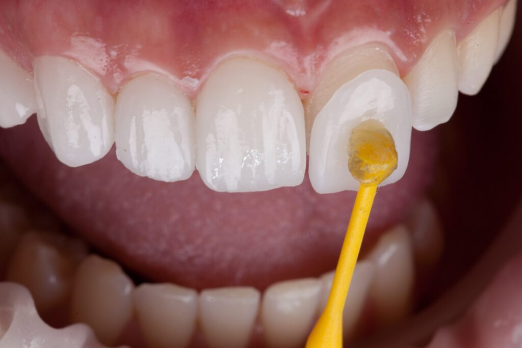 porcelain veneers procedure