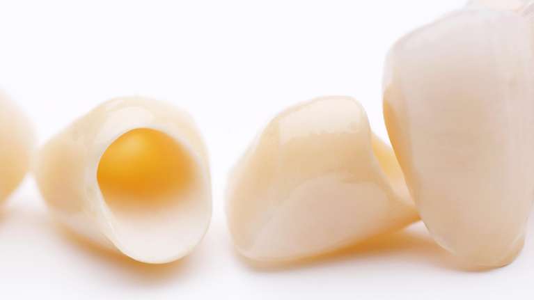 All-ceramic crown