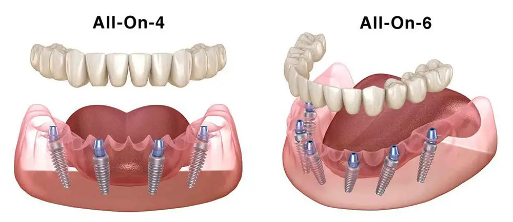 All-on-6 Implants vs. All-on-4