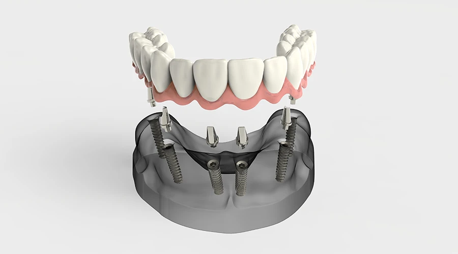 Benefits of All-on-6 Implants