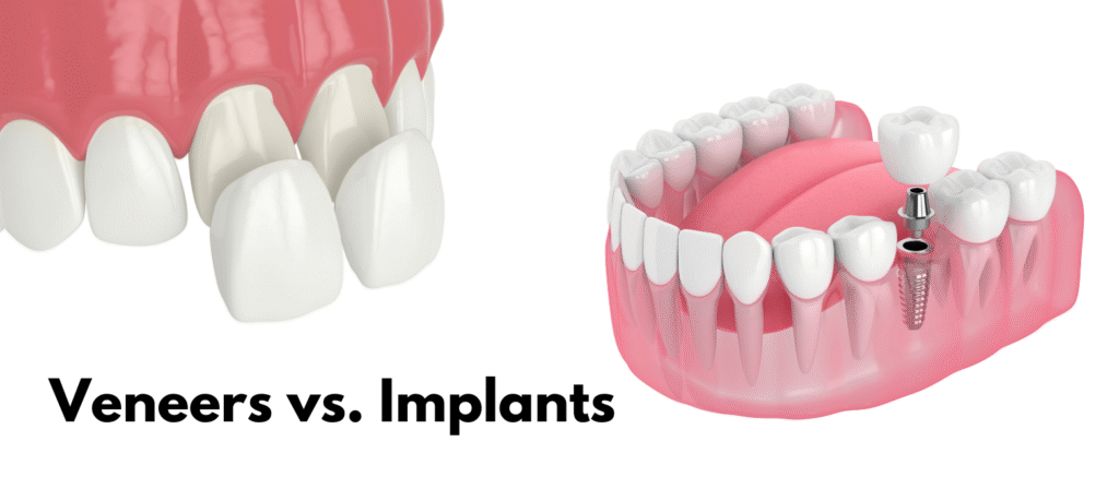 Dental Implants vs Veneers