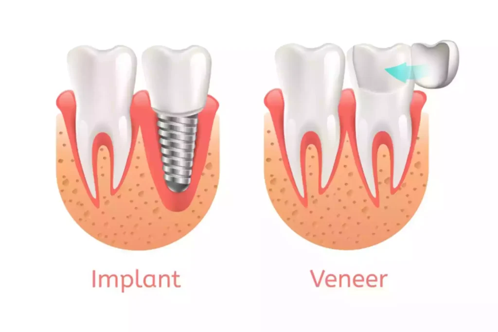 Differences Between Dental Implants and Veneers