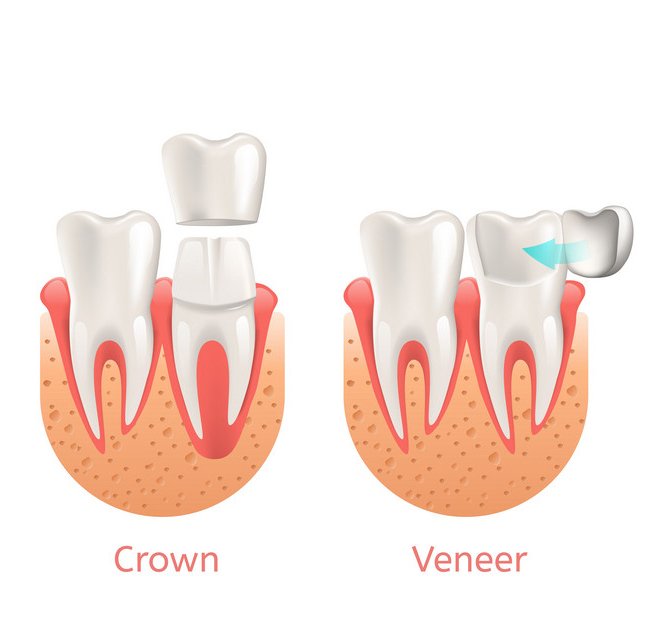 Differences Between Veneers and Crowns