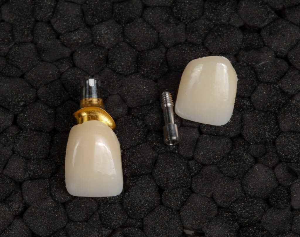 Dental Implants