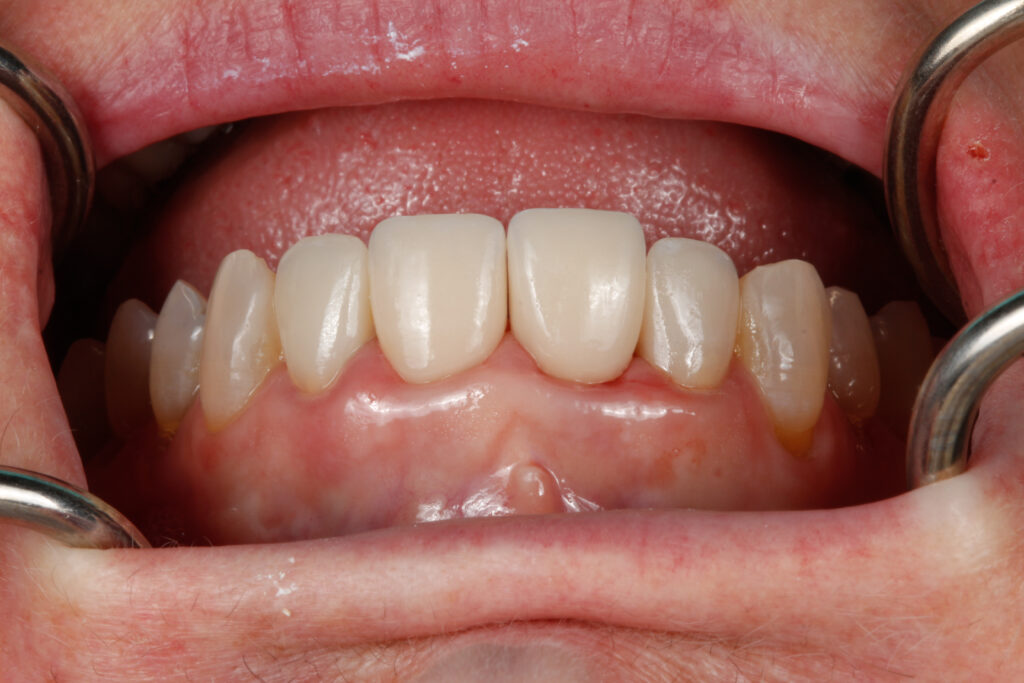 Durability and Longevity of crown