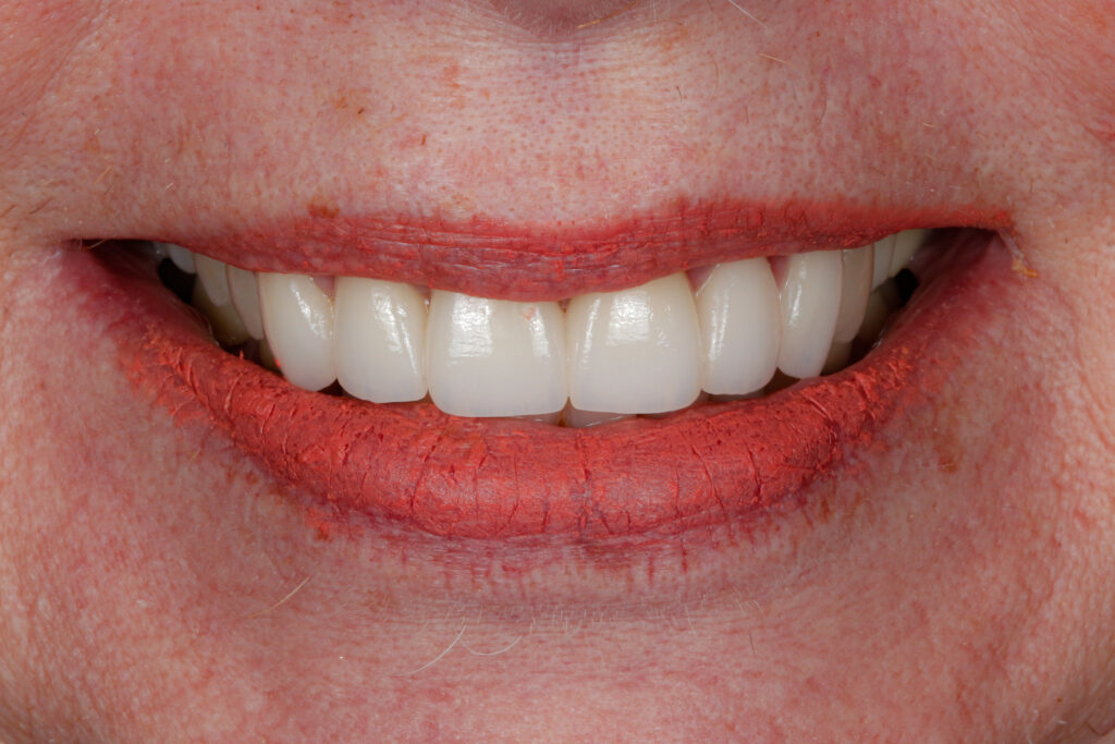 dental veneers