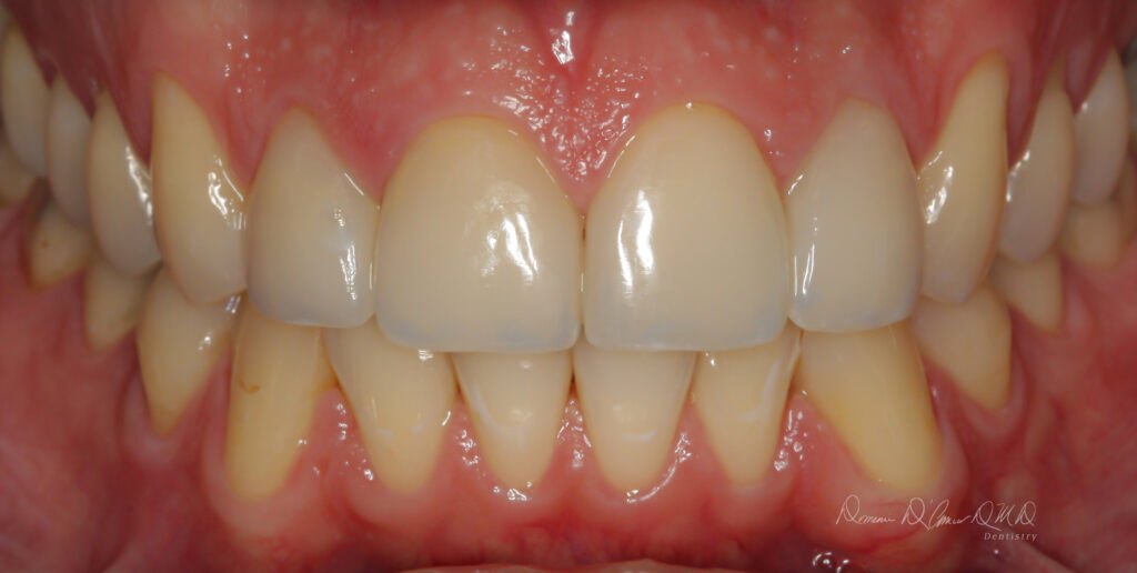 Porcelain Dental Crowns