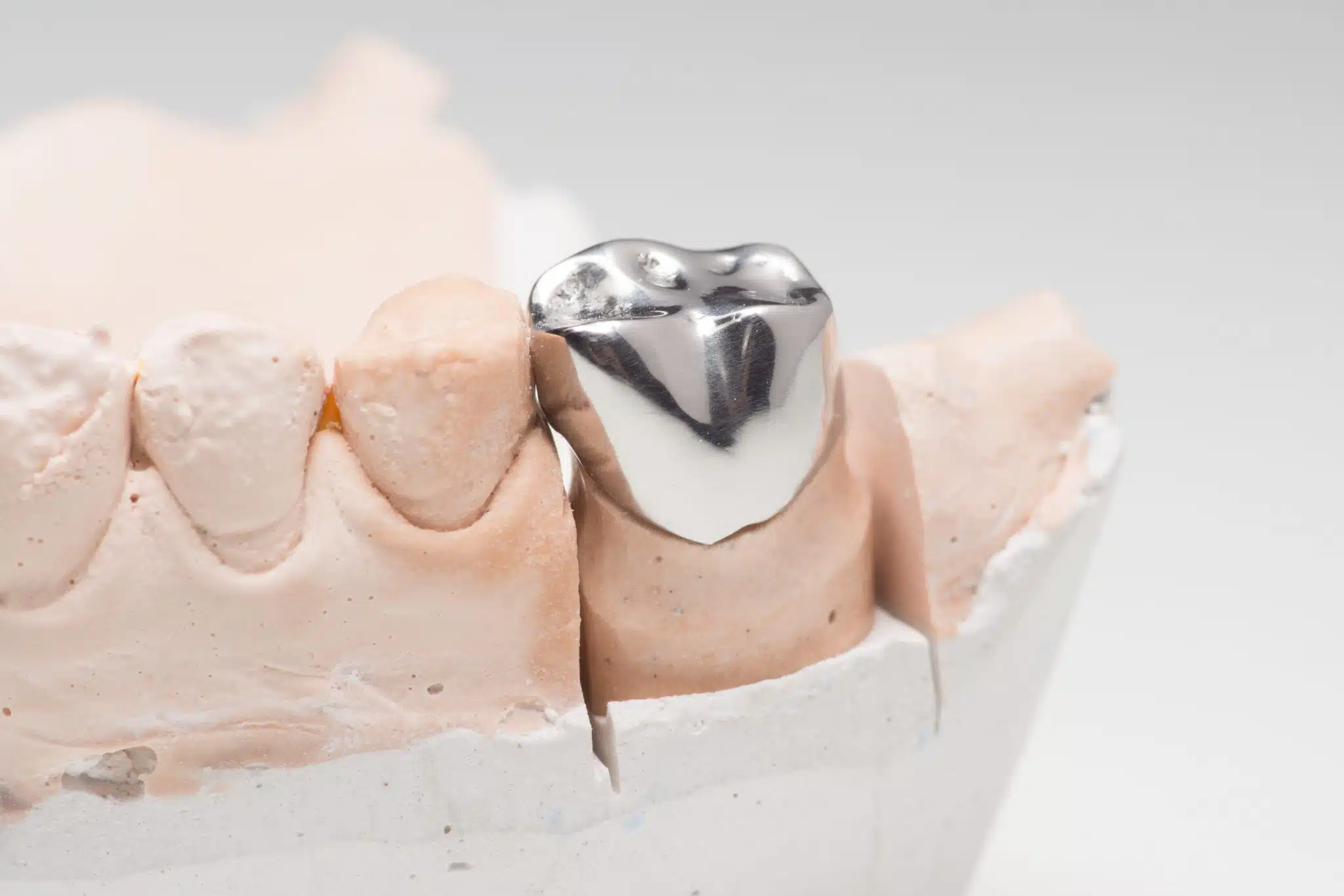 Metal Crowns
